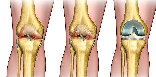 what is arthrosis