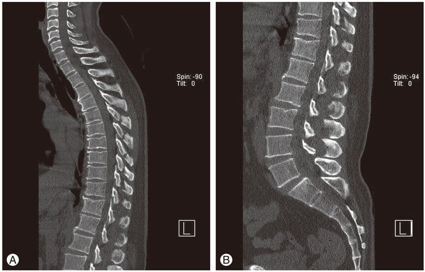 Deformation of intervertebral discs on magnetic resonance imaging in thoracic osteochondrosis