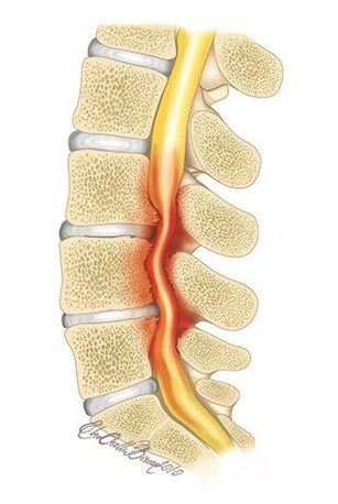 With osteochondrosis of the thoracic spine, compression of the spinal canal occurs