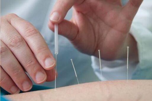 Acupuncture - a method of treating lower back pain caused by osteochondrosis